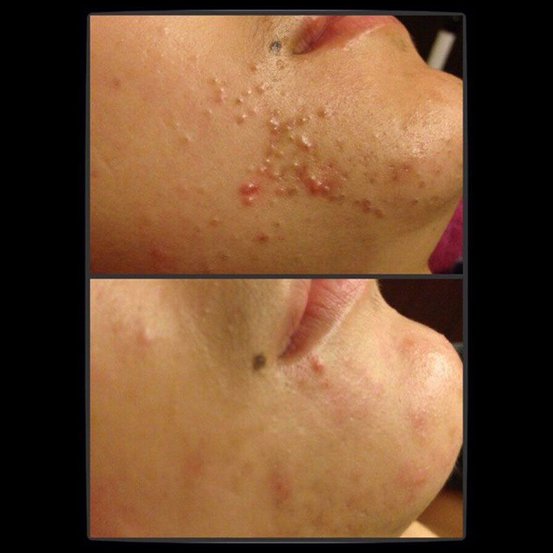 煩惱著腦人痘痘~與粉刺